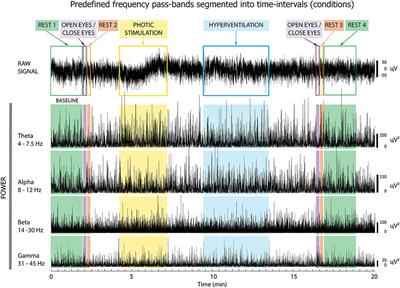 EEG Reactivity Predicts Individual Efficacy of Vagal Nerve Stimulation in Intractable Epileptics